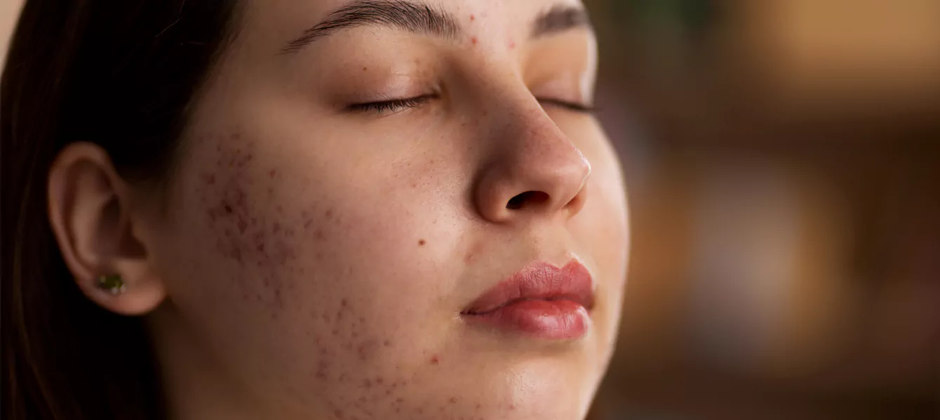 Diagnosis and treatment of facial skin infections at SCC West